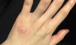 什么虫子咬了会起水泡 哪些虫子咬了会起水泡