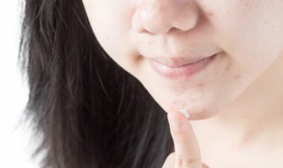 油皮祛痘土方法 怎么快速祛痘的方法小妙招
