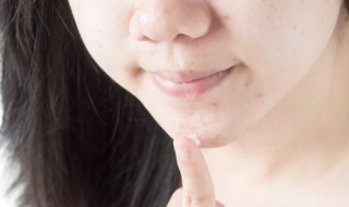 男士脸上长痘痘用什么方法能好 男士脸上长痘痘怎么办