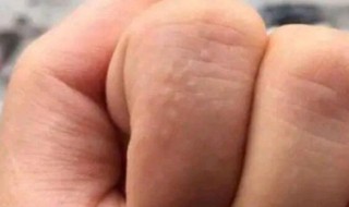 手上起小水泡很痒怎么回事 手上起小水泡很痒的原因