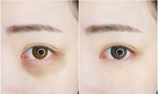 黑眼圈与眼袋去除方法 黑眼圈与眼袋如何去除