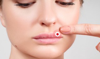 嘴溃疡最快治疗方法 口腔溃疡最快治疗方法