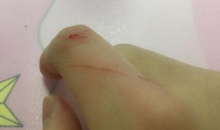 被猫抓了一定要打针吗？ 被猫抓了是不是一定要打针