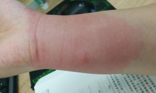 红火蚁咬了红肿痒怎么办 红火蚁咬了红肿痒解决办法